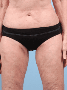 Thigh Lift - Case 16775 - After