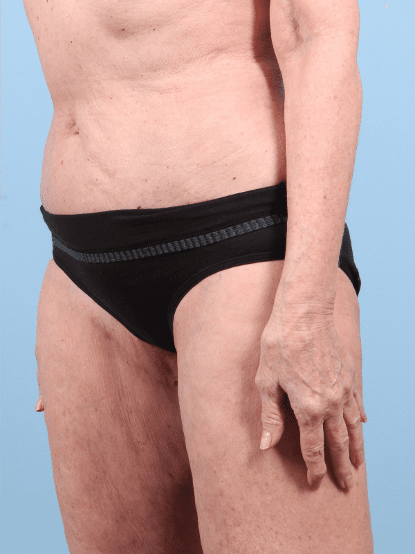Thigh Lift Patient Photo - Case 16775 - after view-1