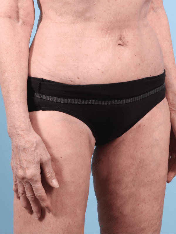 Thigh Lift Patient Photo - Case 16775 - after view-2