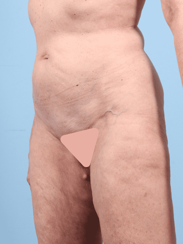 Thigh Lift Patient Photo - Case 16775 - before view-1
