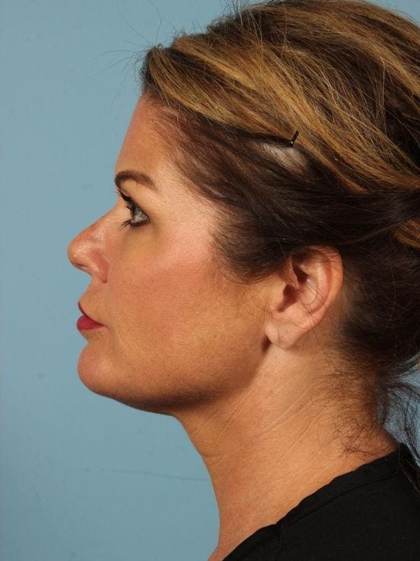 Y Lift Patient Photo - Case 16807 - after view-1