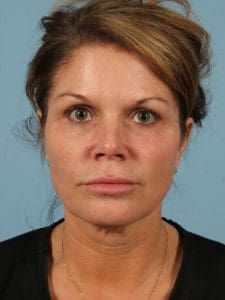 Y Lift - Case 16807 - Before