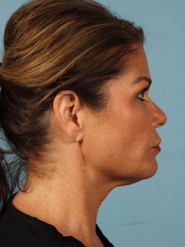 Y Lift Patient Photo - Case 16807 - after view-2