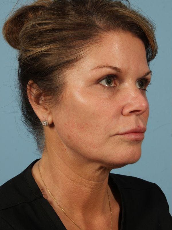 Y Lift Patient Photo - Case 16807 - before view-4