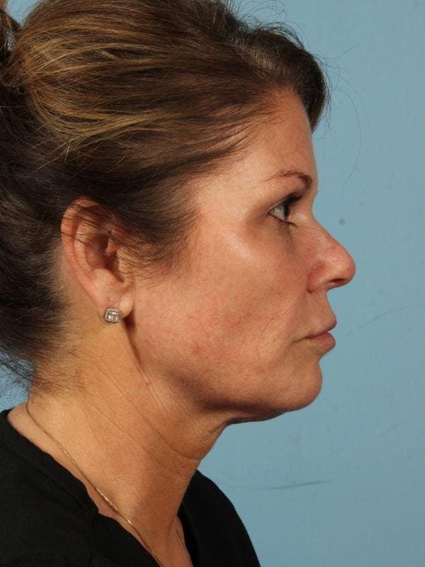 Y Lift Patient Photo - Case 16807 - before view-2