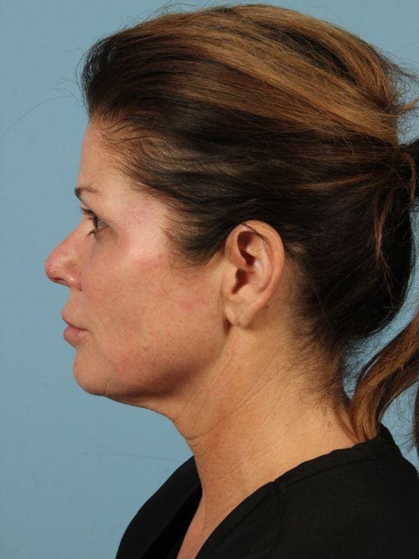 Y Lift Patient Photo - Case 16807 - before view-1