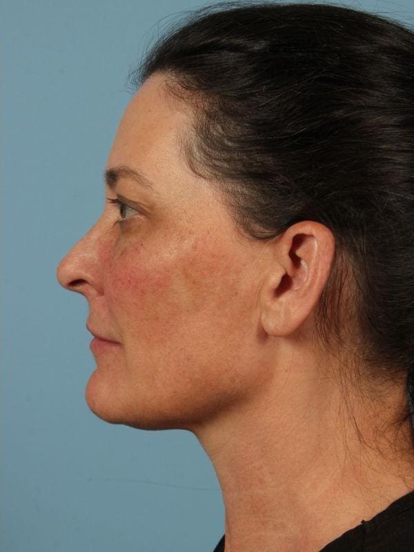 Y Lift Patient Photo - Case 16819 - after view-1