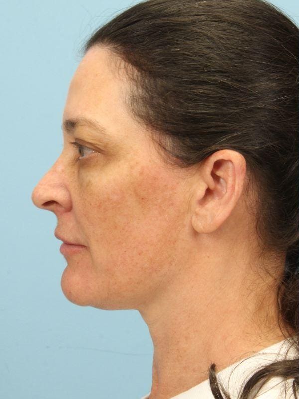 Y Lift Patient Photo - Case 16819 - before view-1