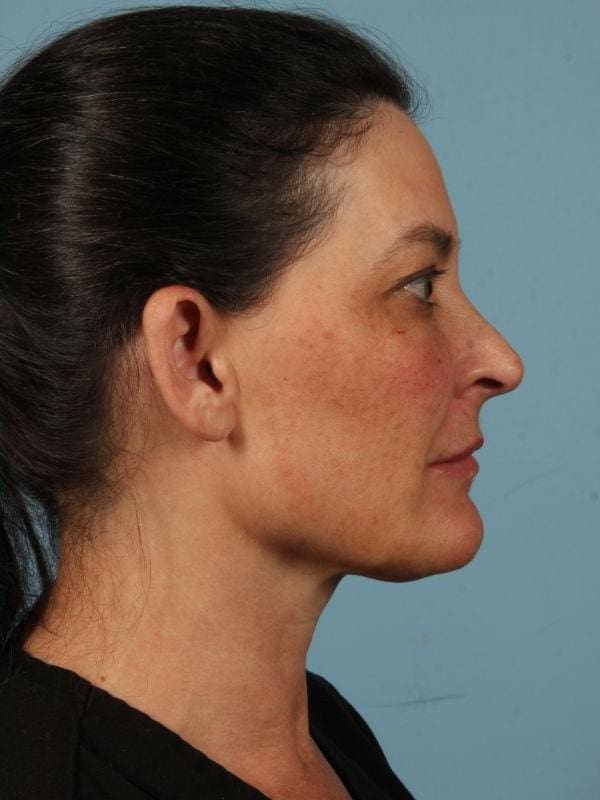 Y Lift Patient Photo - Case 16819 - after view-2