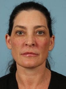 Y Lift - Case 16819 - After