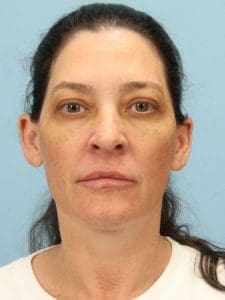 Y Lift - Case 16819 - Before