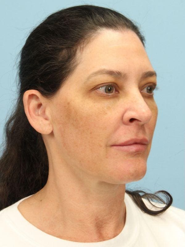 Y Lift Patient Photo - Case 16819 - before view-4