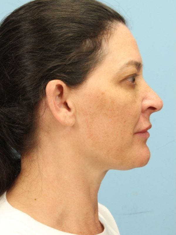 Y Lift Patient Photo - Case 16819 - before view-2