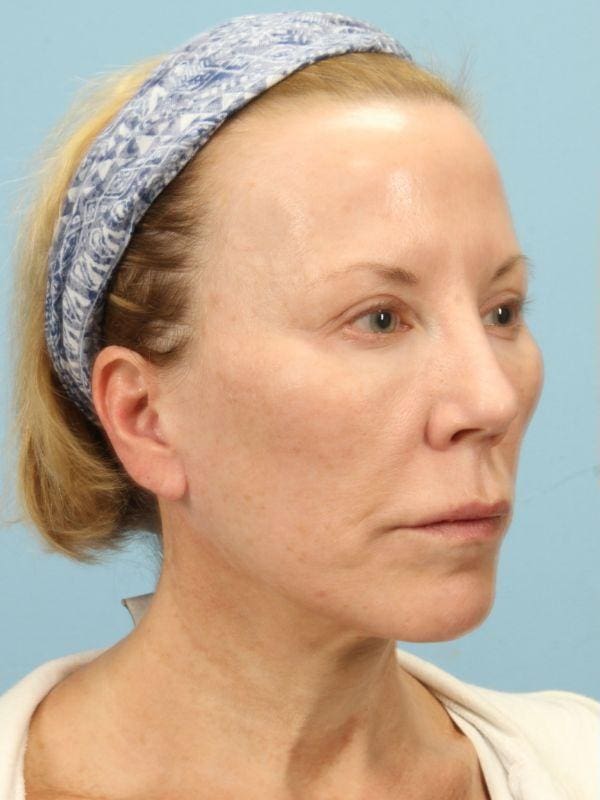 Y Lift Patient Photo - Case 16832 - before view-4