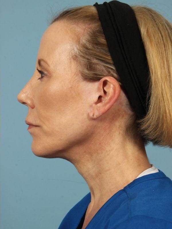 Y Lift Patient Photo - Case 16832 - after view-1