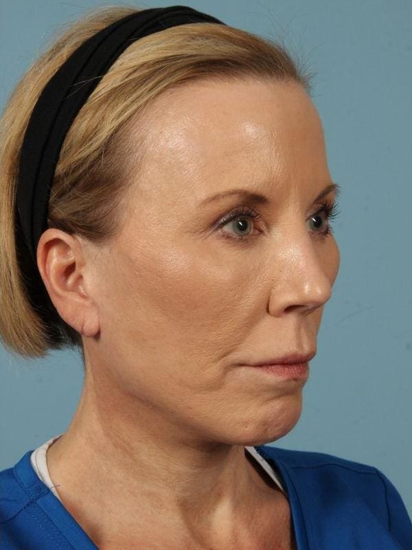 Y Lift Patient Photo - Case 16832 - after view-4