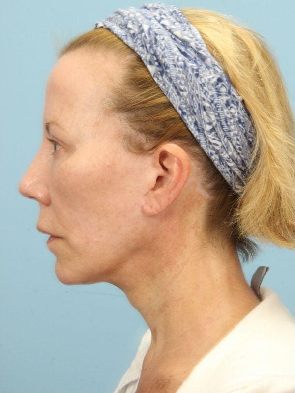 Y Lift Patient Photo - Case 16832 - before view-1