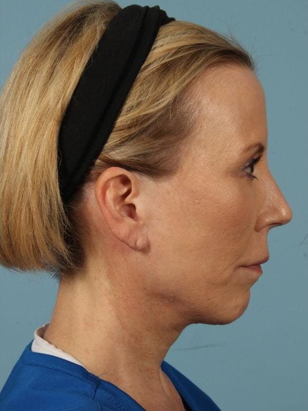 Y Lift Patient Photo - Case 16832 - after view-2