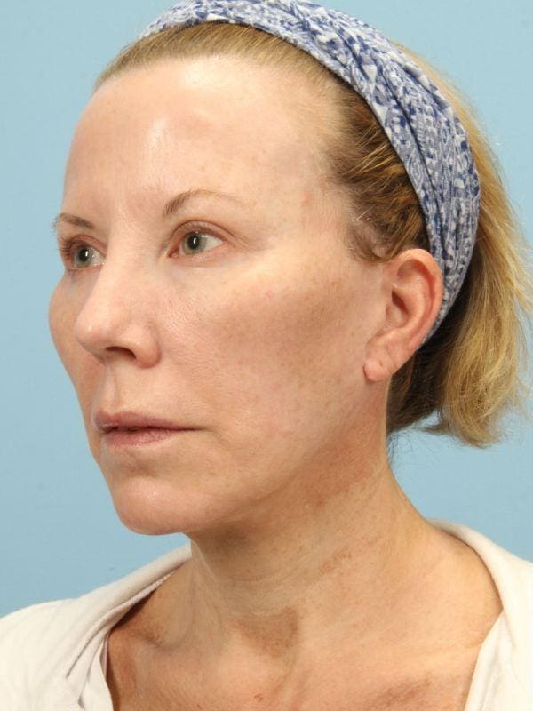 Y Lift Patient Photo - Case 16832 - before view-3