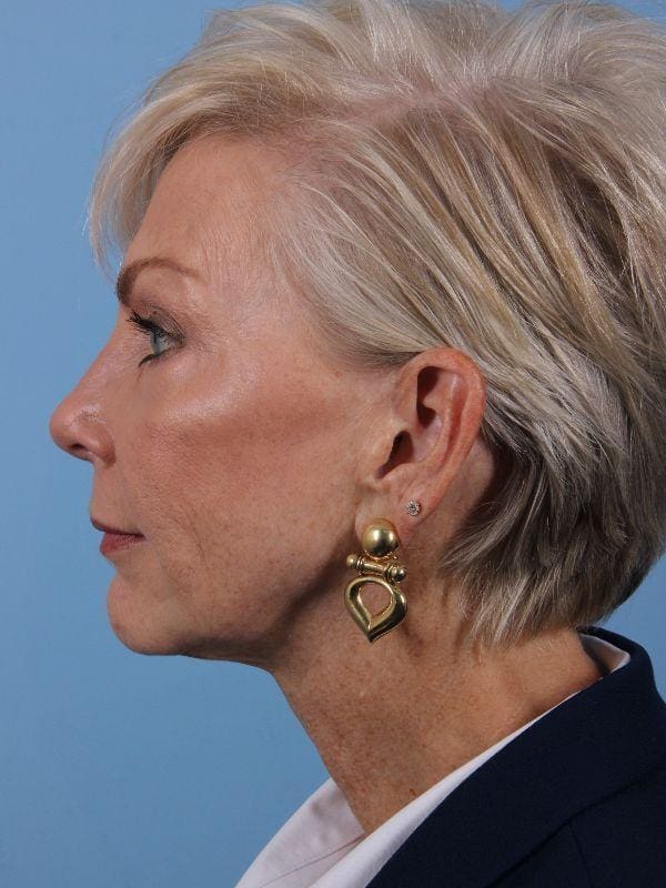 Y Lift Patient Photo - Case 16845 - before view-1