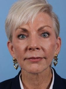 Y Lift - Case 16845 - Before