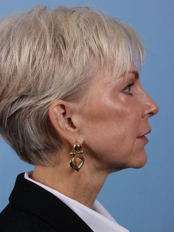 Y Lift Patient Photo - Case 16845 - after view-2