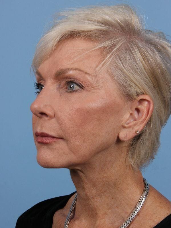 Y Lift Patient Photo - Case 16864 - before view-3