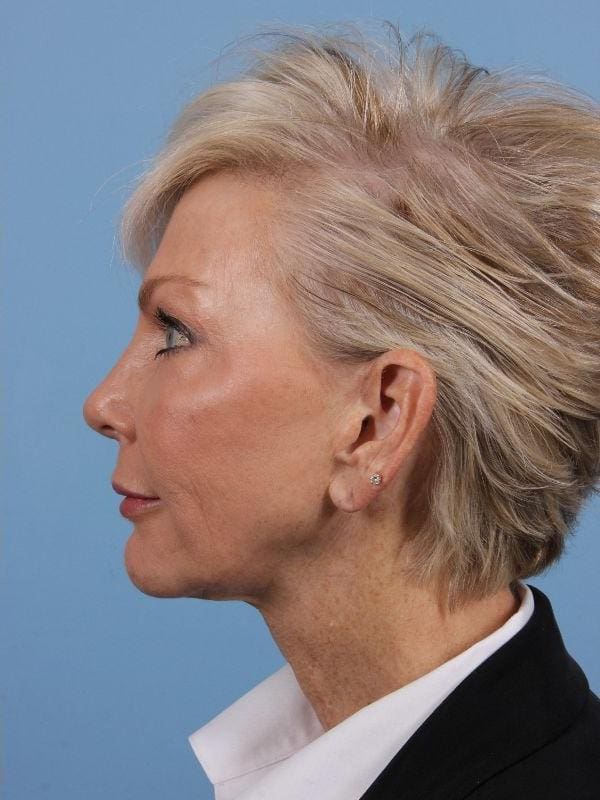 Y Lift Patient Photo - Case 16864 - after view-1