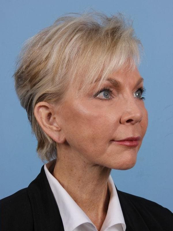 Y Lift Patient Photo - Case 16864 - after view-4