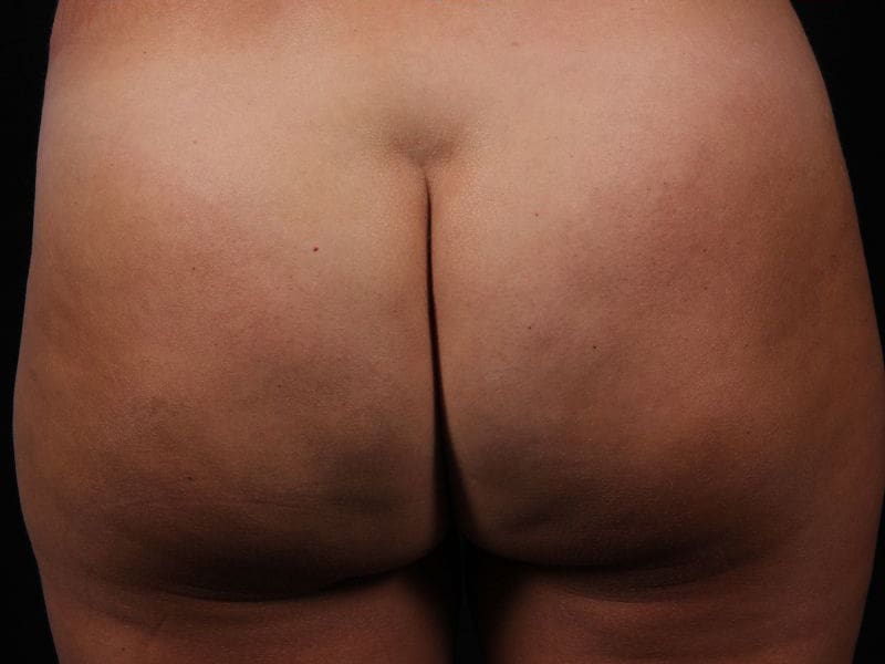 Cellulite Reduction Patient Photo - Case 16876 - after view
