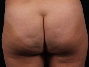 Cellulite Reduction - Case 16876 - Before