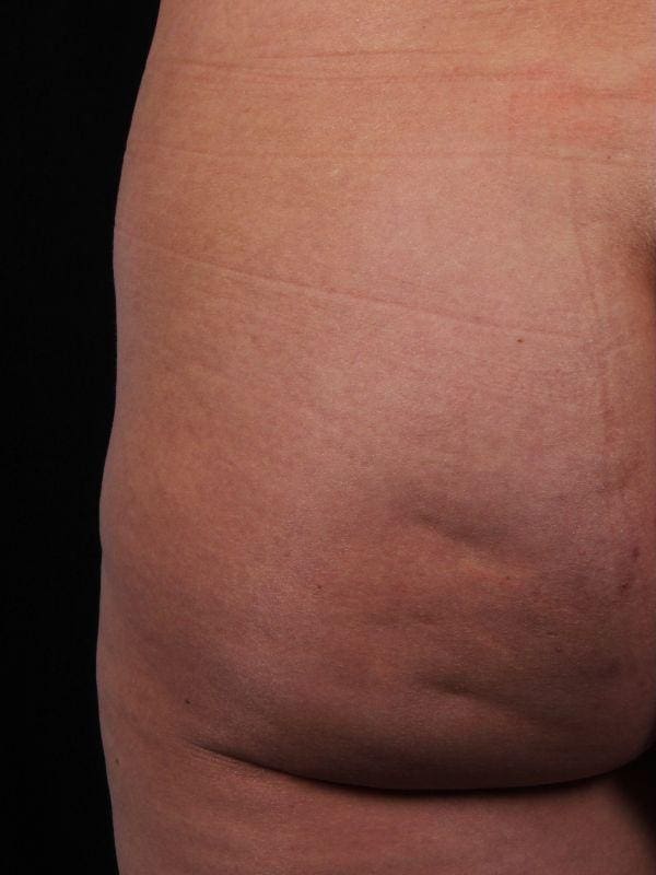 Cellulite Reduction Patient Photo - Case 16884 - before view-1