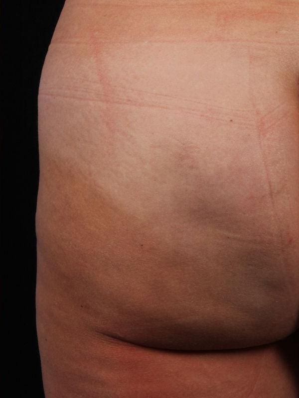 Cellulite Reduction Patient Photo - Case 16884 - after view-1