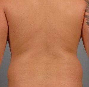Liposuction Patient Photo - Case 16890 - before view-3