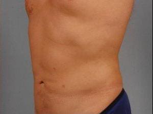 Liposuction Patient Photo - Case 16890 - after view-2