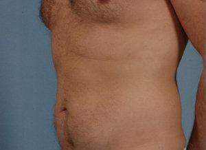 Liposuction Patient Photo - Case 16890 - before view-2
