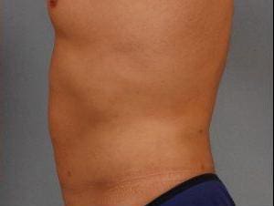 Liposuction Patient Photo - Case 16890 - after view-1