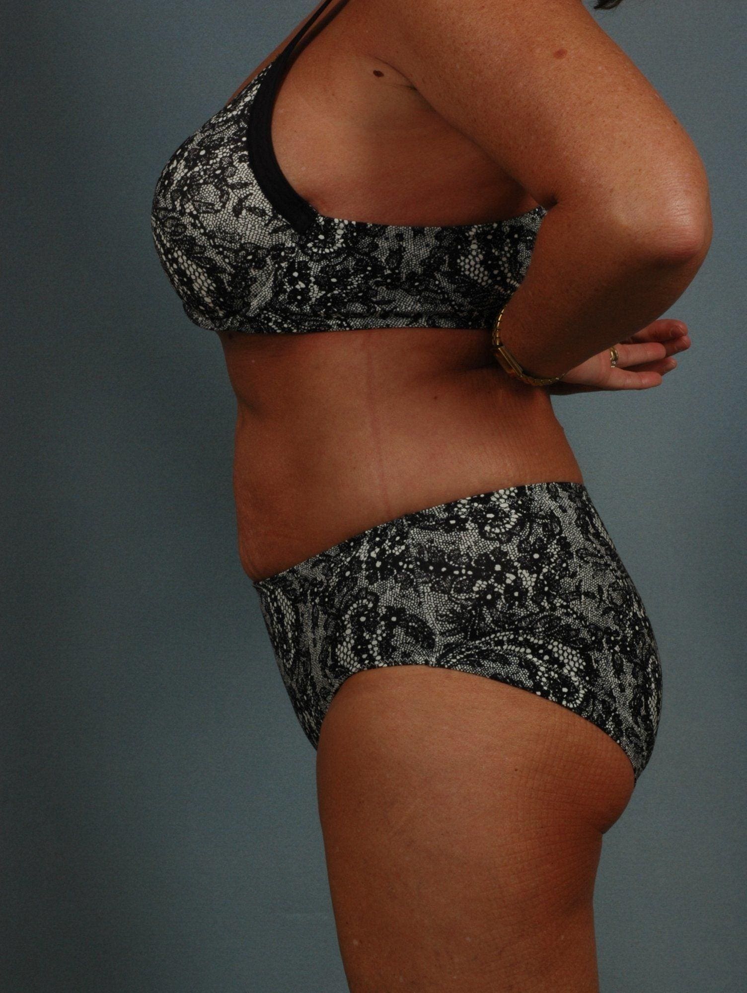 Liposuction Patient Photo - Case 16905 - after view