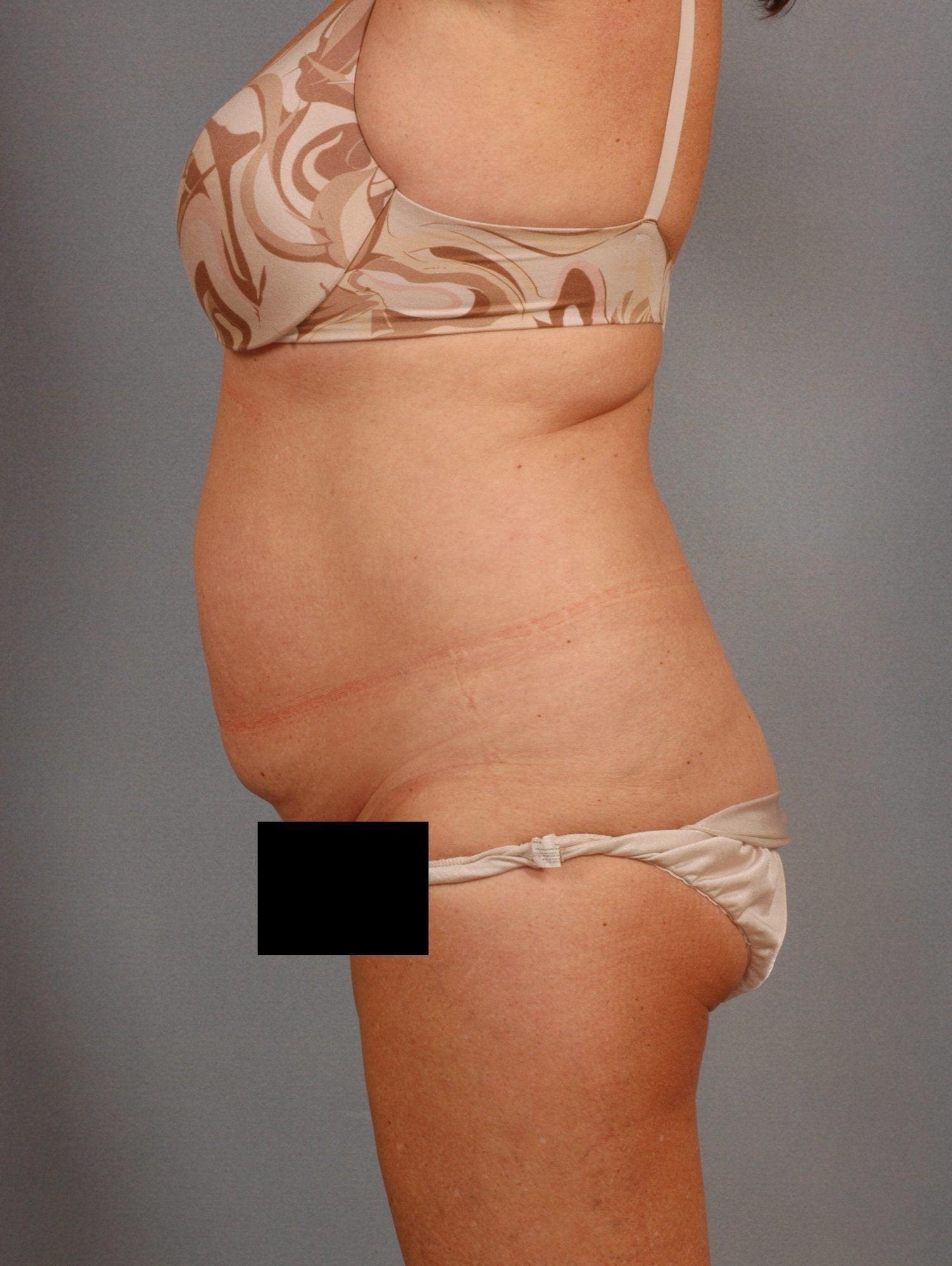 Liposuction Patient Photo - Case 16905 - before view-