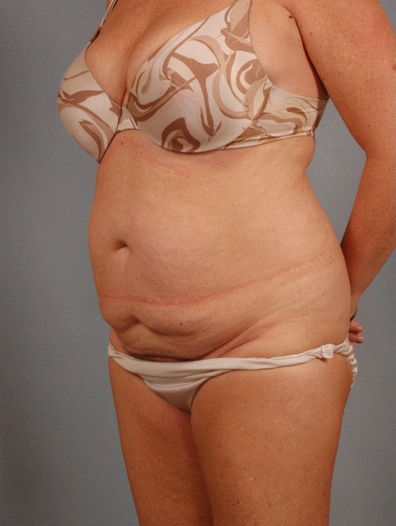 Liposuction Patient Photo - Case 16905 - before view-2