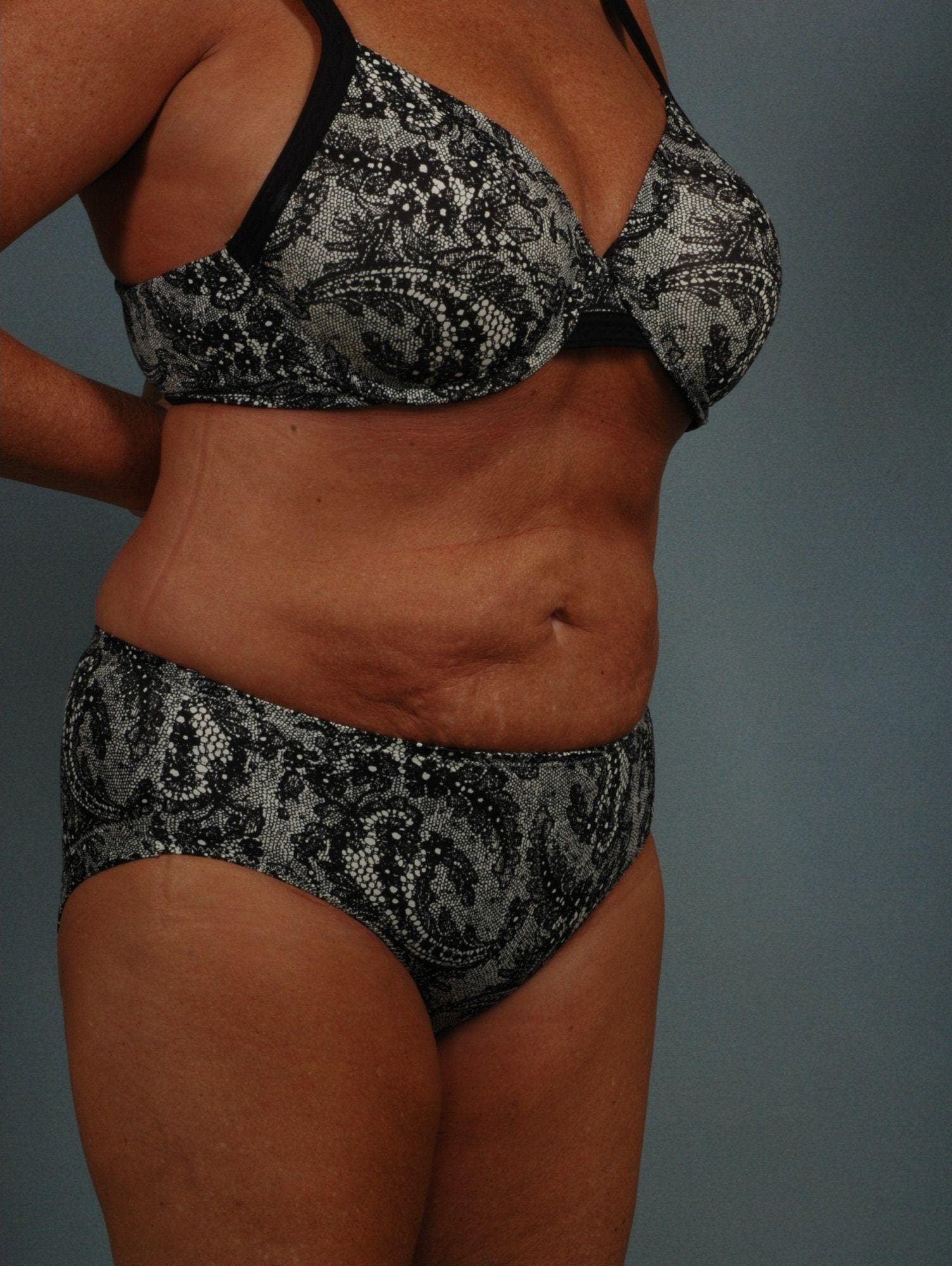 Liposuction Patient Photo - Case 16905 - after view-3