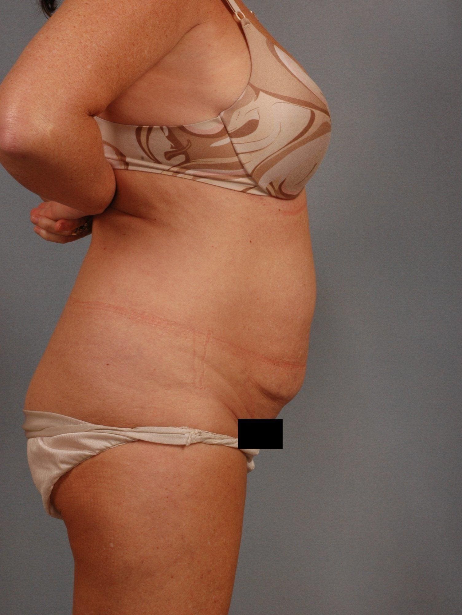 Liposuction Patient Photo - Case 16905 - before view-1