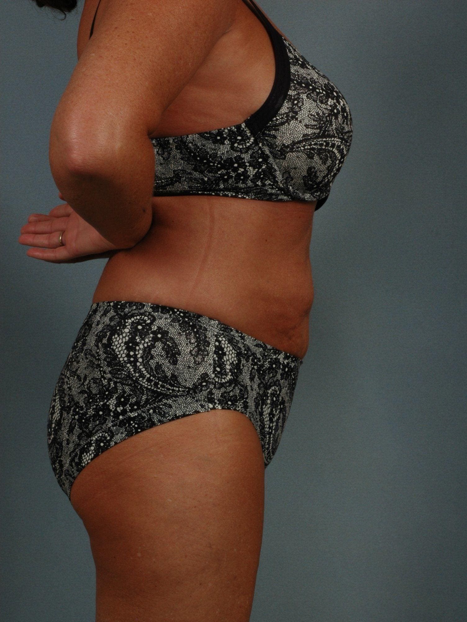 Liposuction Patient Photo - Case 16905 - after view-1