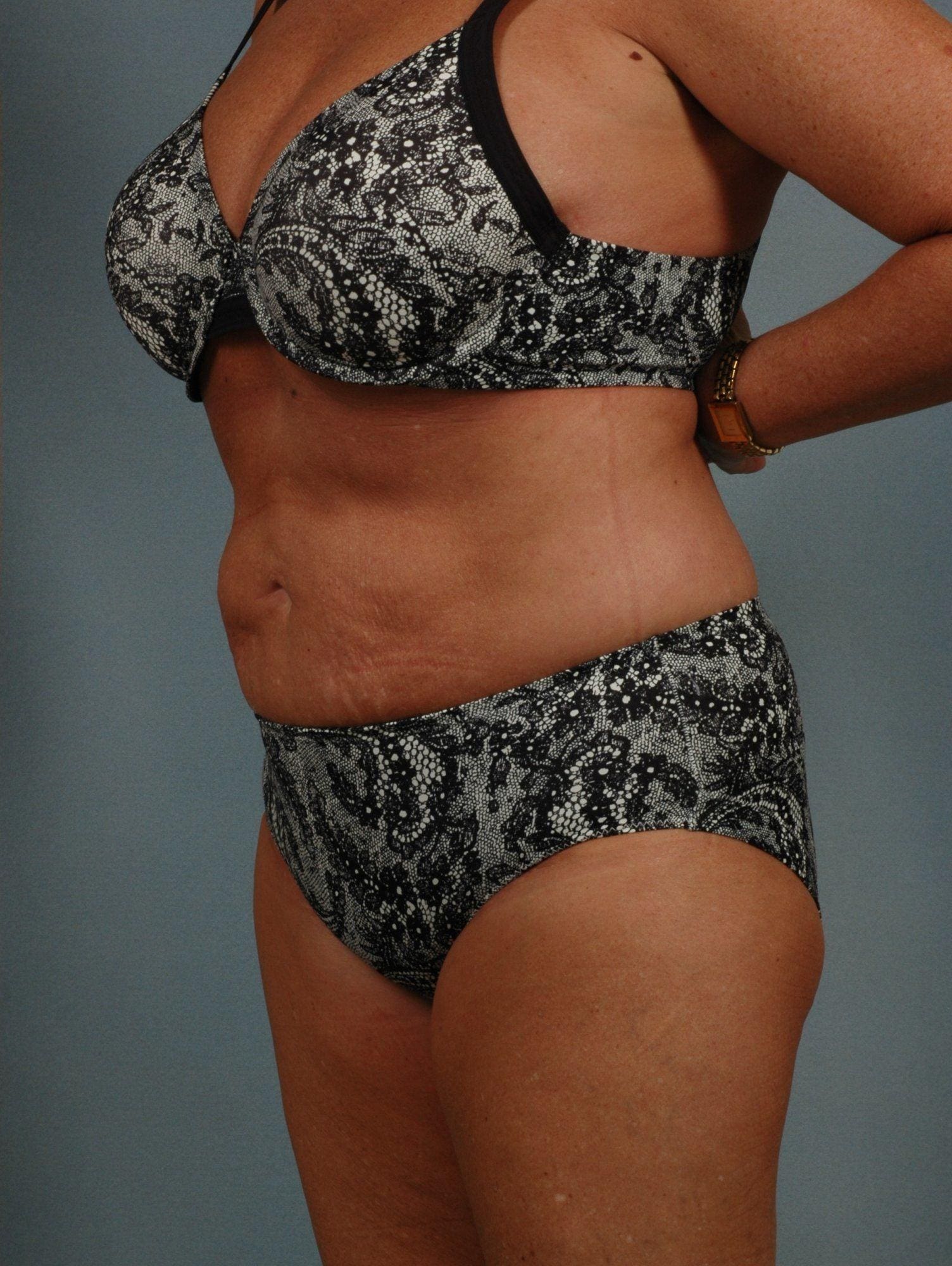 Liposuction Patient Photo - Case 16905 - after view-2
