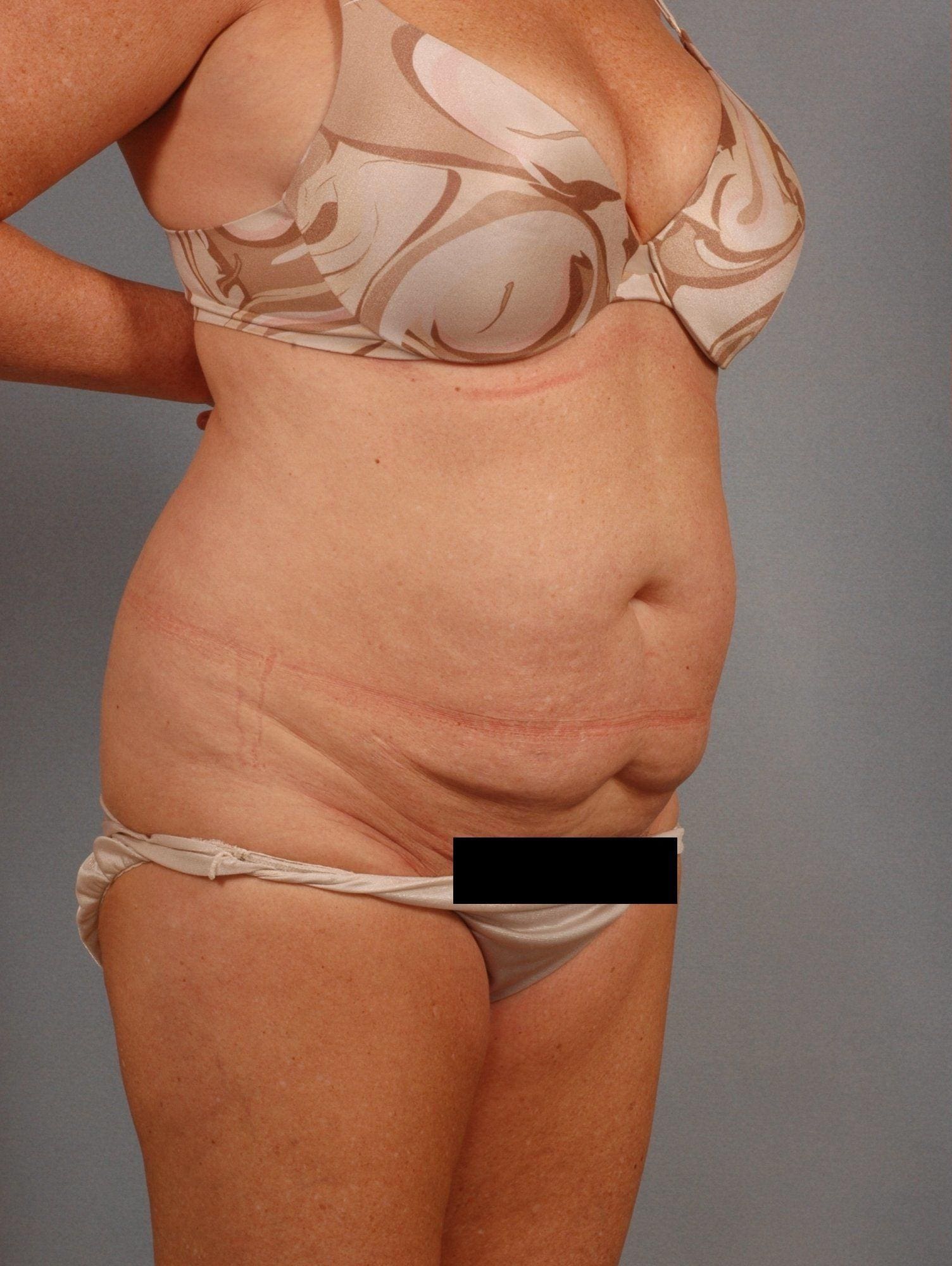 Liposuction Patient Photo - Case 16905 - before view-3