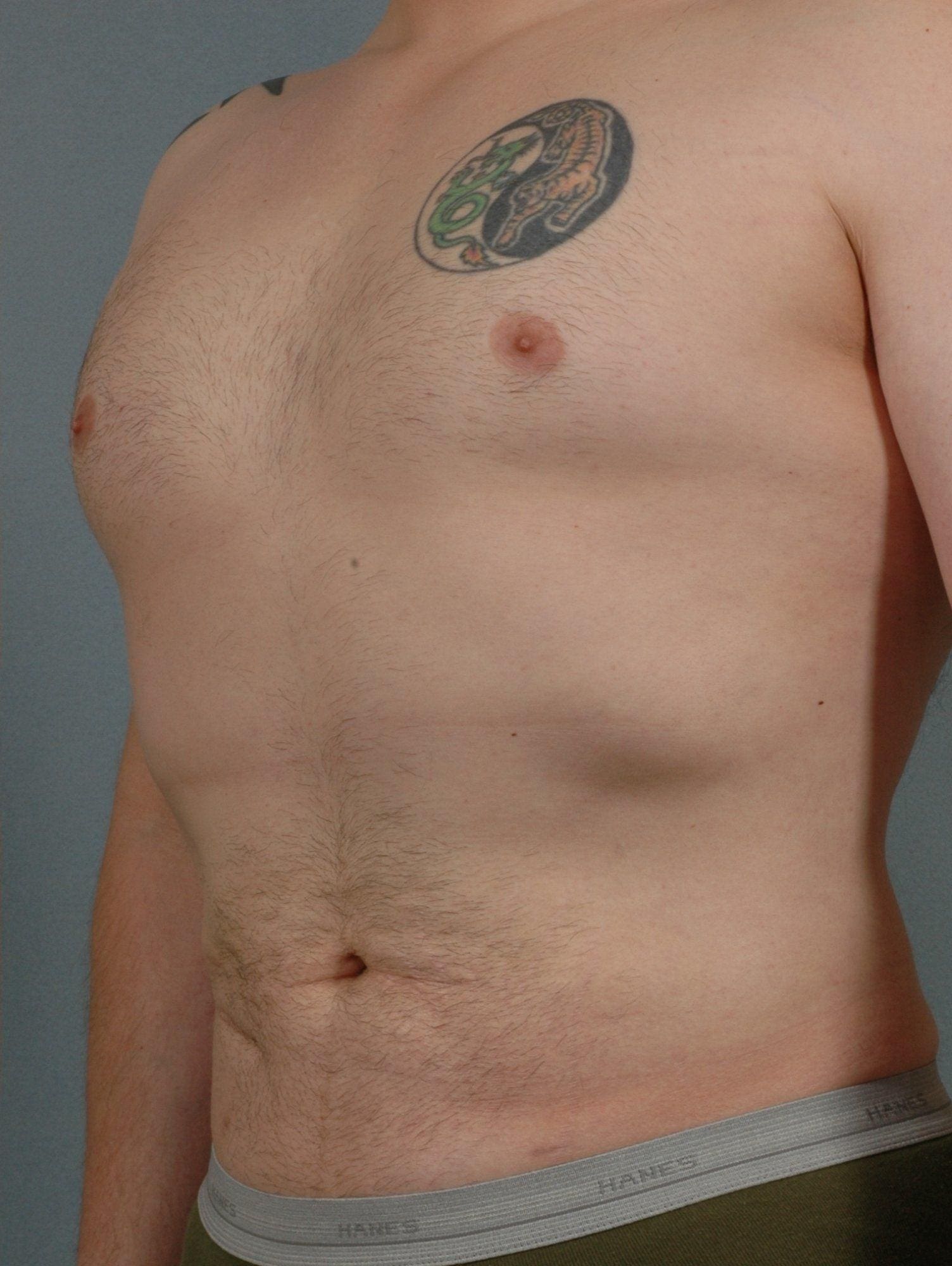 Liposuction Patient Photo - Case 16915 - after view-1