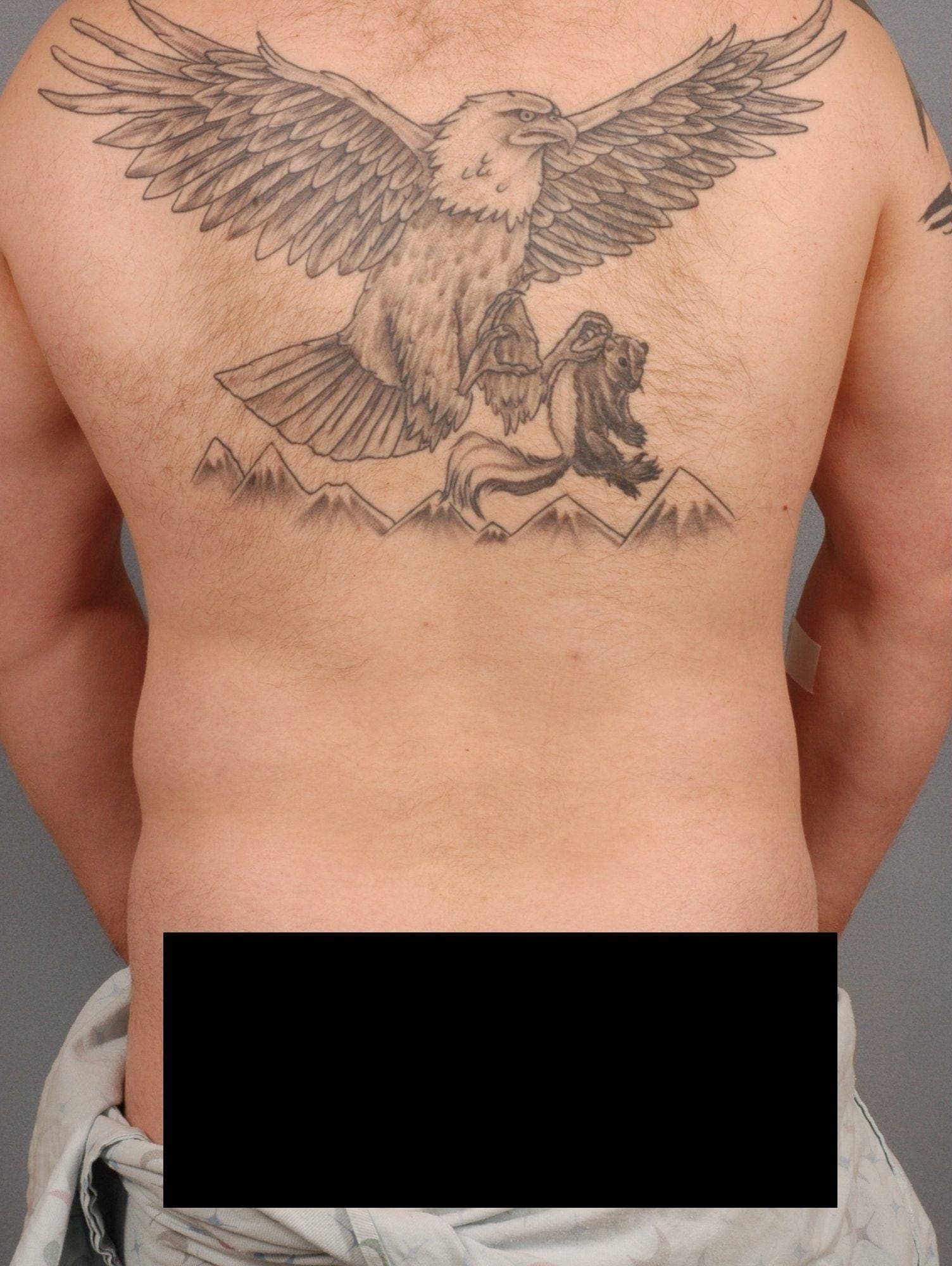 Liposuction Patient Photo - Case 16915 - before view-2