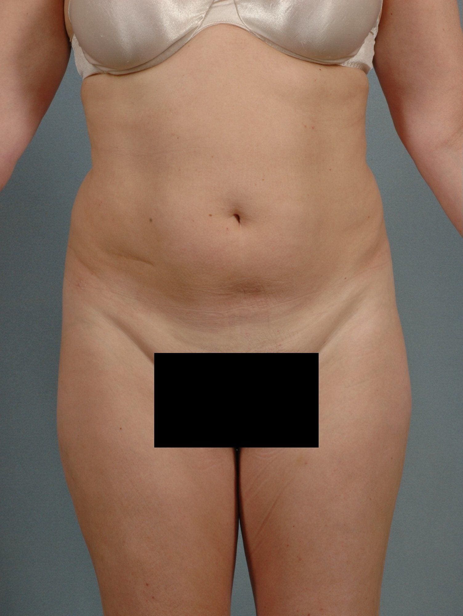 Liposuction Patient Photo - Case 16923 - before view-