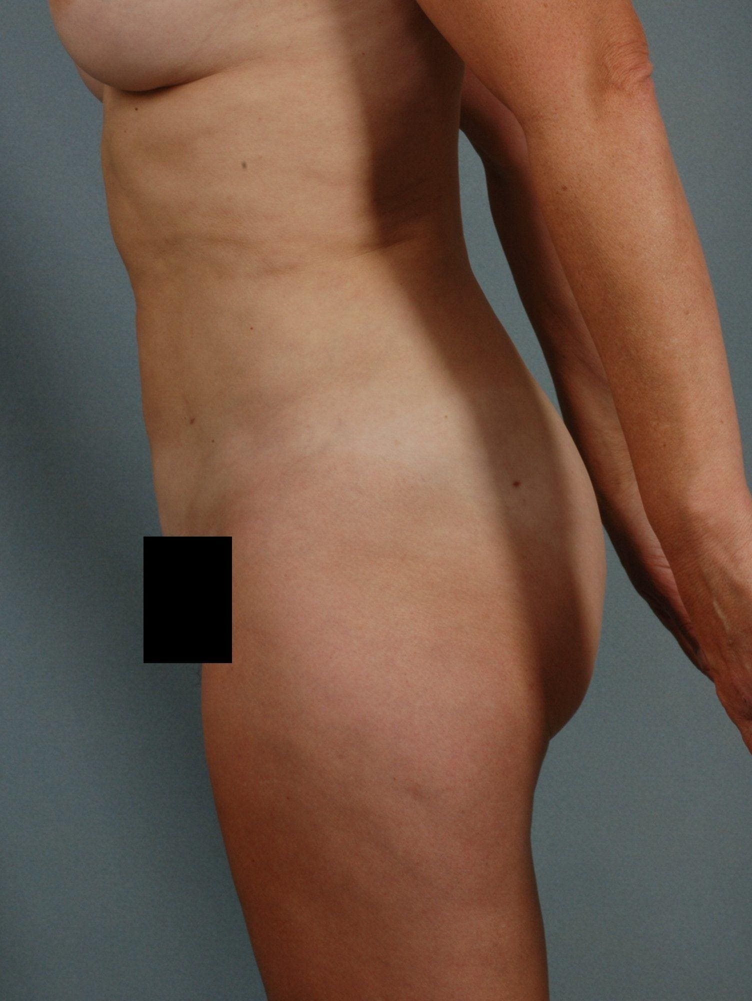 Liposuction Patient Photo - Case 16923 - after view-1