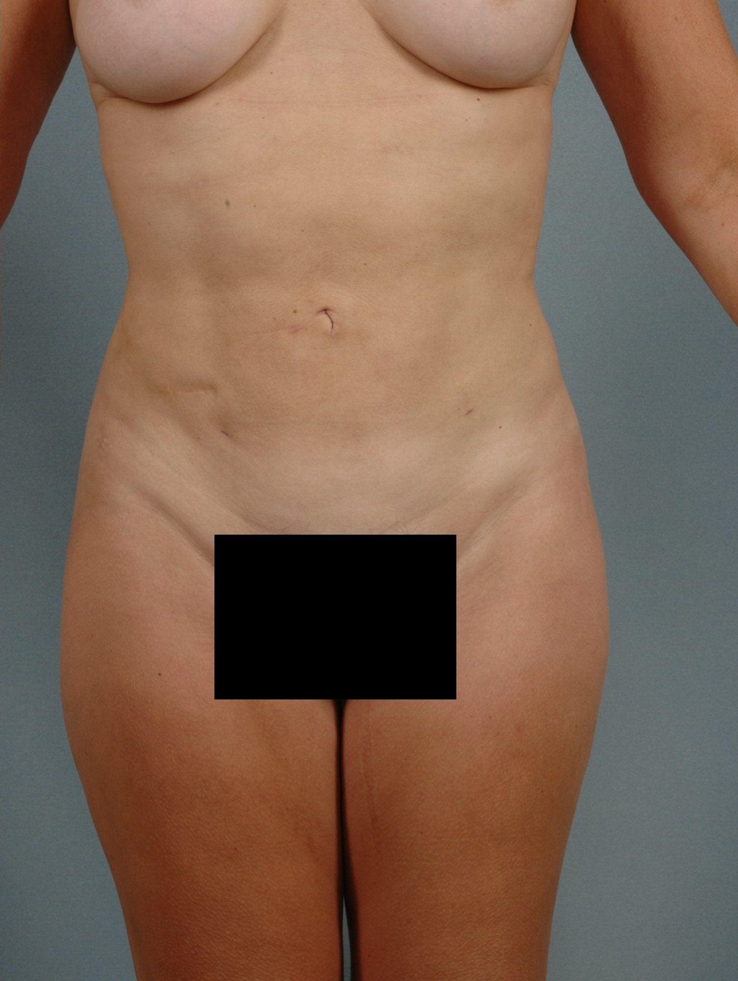 Liposuction Patient Photo - Case 16923 - after view